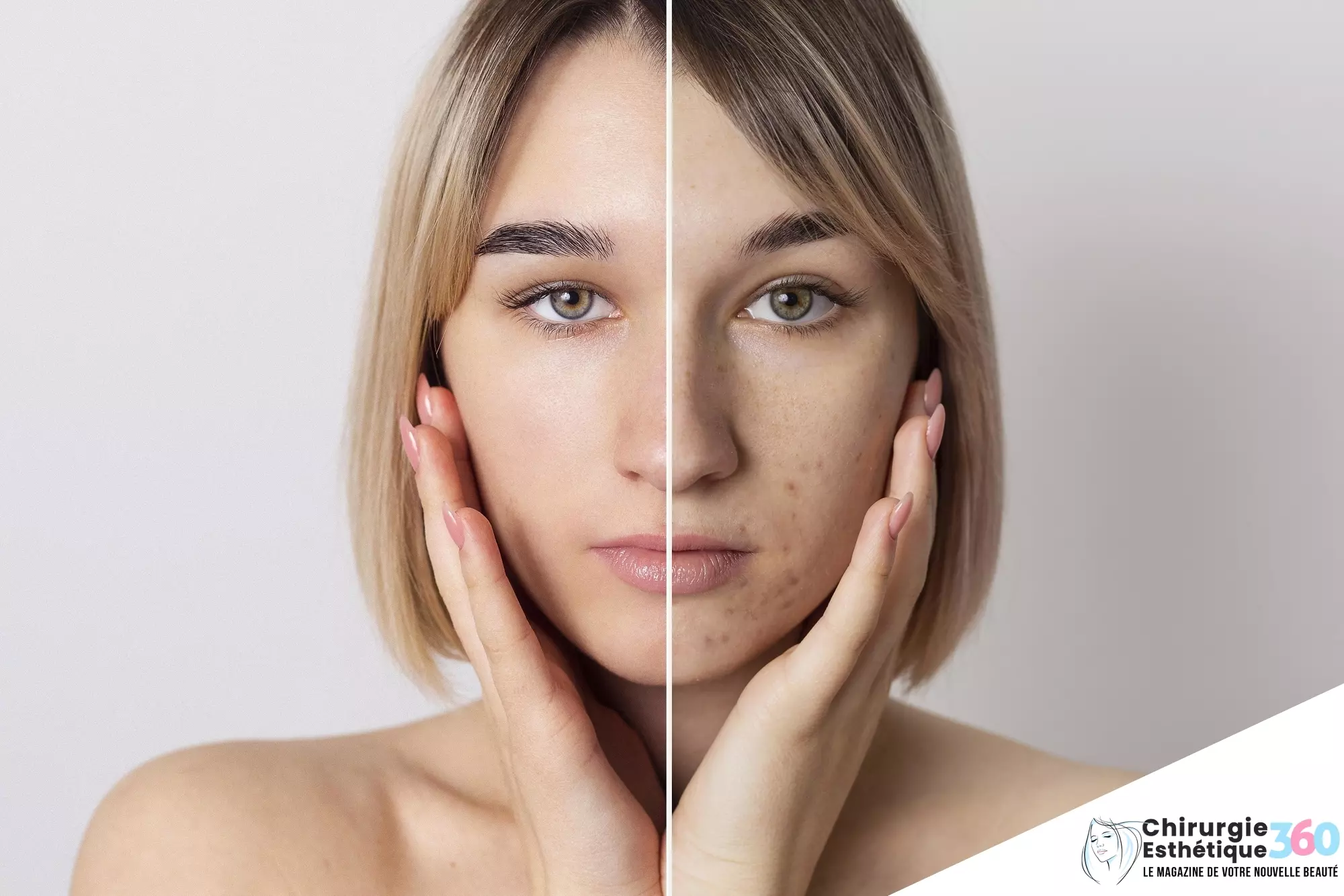 Transformation étonnante : avant et après d'un traitement efficace contre l'acné