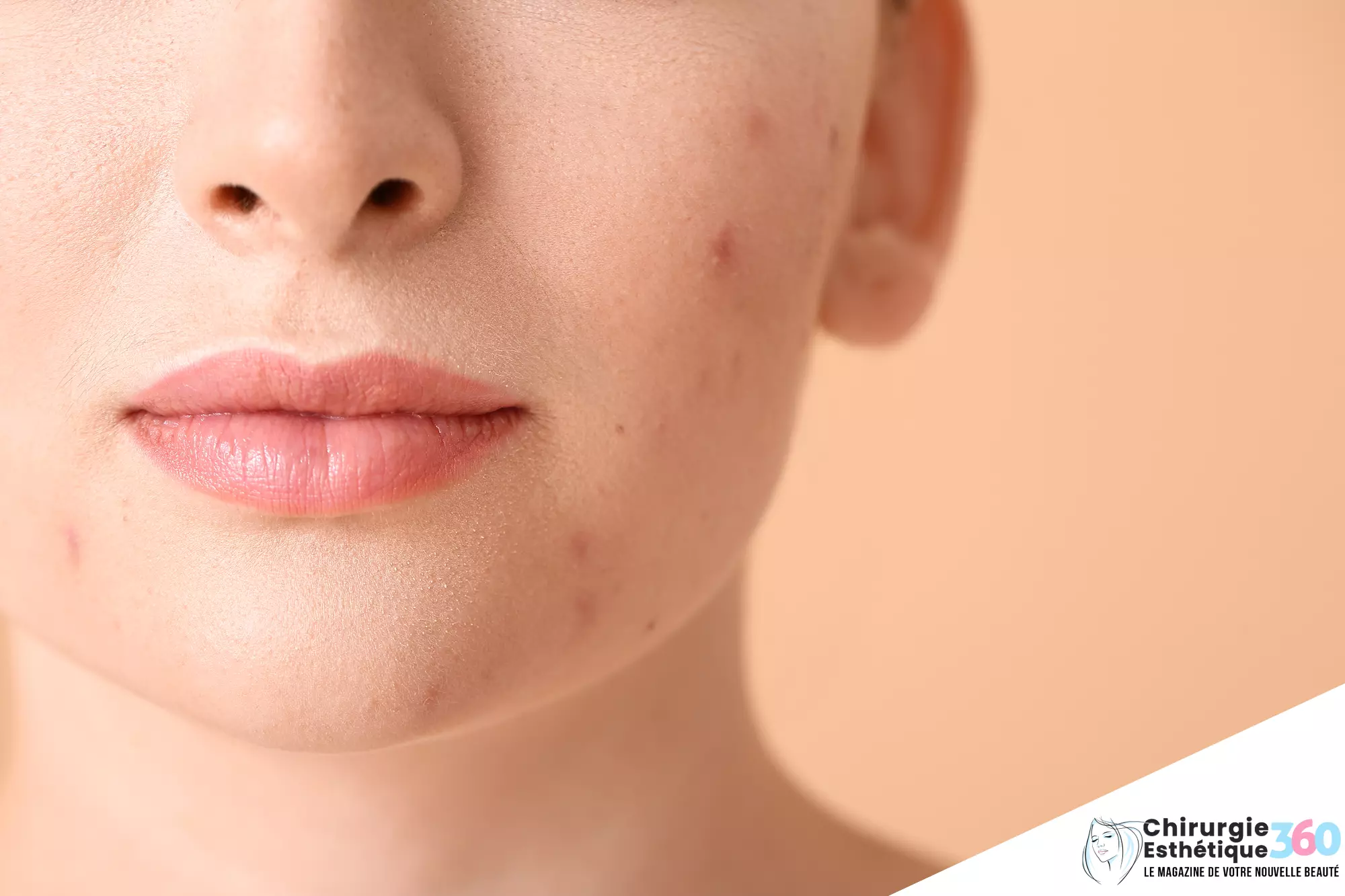 Photo d'un traitements efficaces contre l'acné