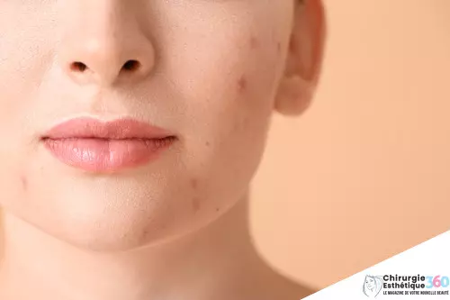 Photo d'un traitements efficaces contre l'acné