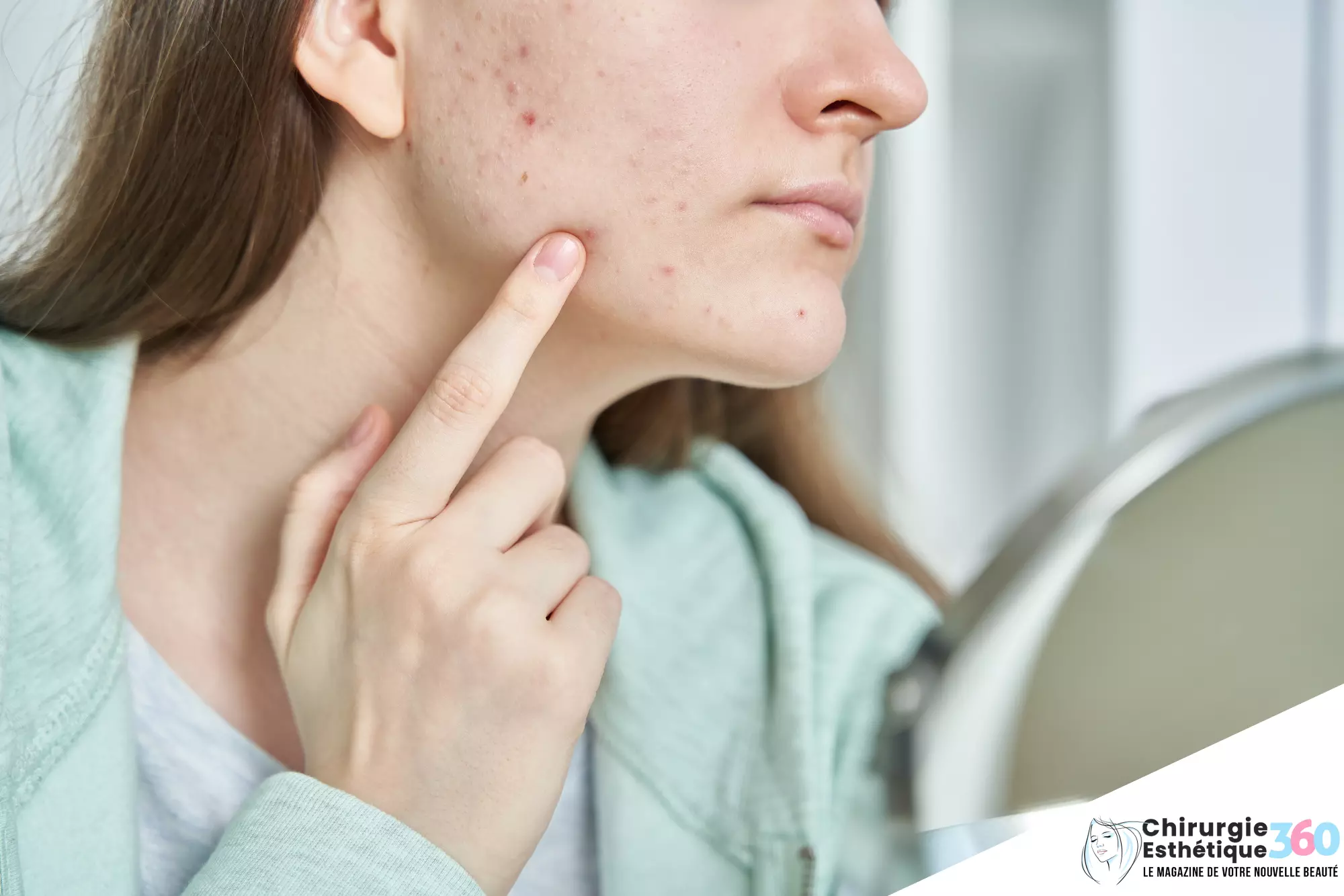 Photo d'une jeune fille avec de l'acné