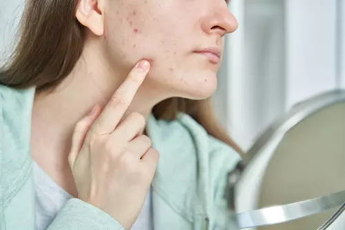 Photo d'une jeune fille avec de l'acné
