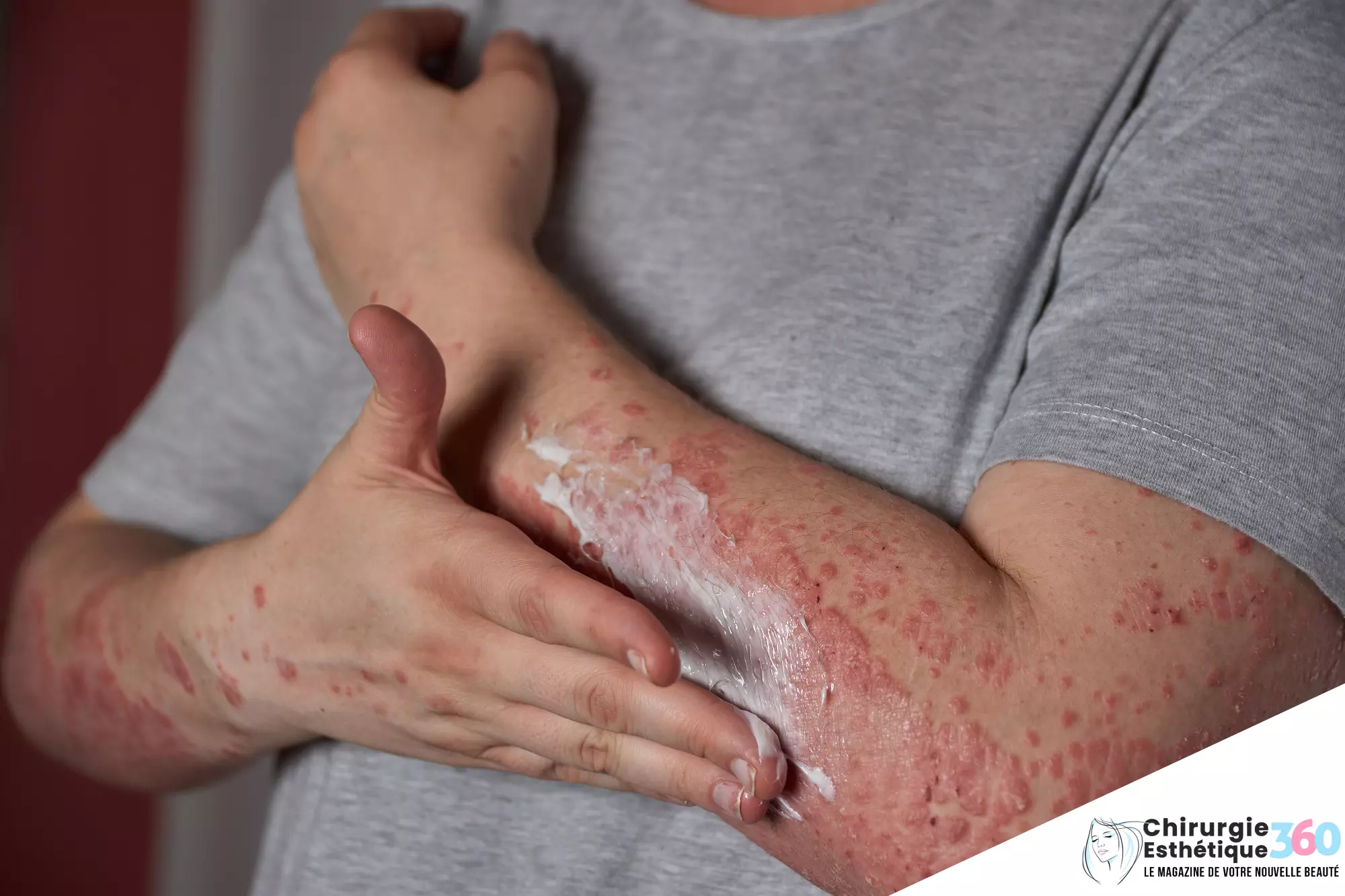 Photo de brûlures cutanées soulagées par une crème hydratante efficace