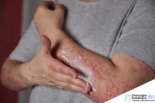 Photo de brûlures cutanées soulagées par une crème hydratante efficace