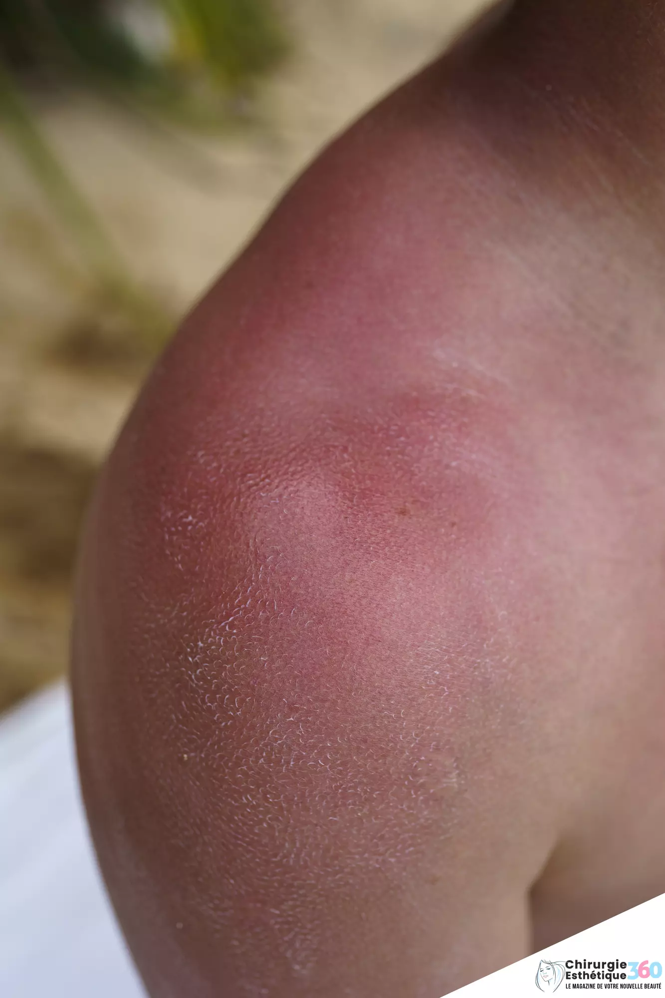 Réparation des brûlures : Conseils et remèdes pour soigner efficacement les peaux exposées au soleil