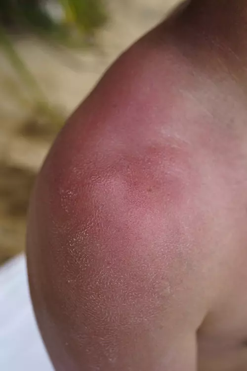 Réparation des brûlures : Conseils et remèdes pour soigner efficacement les peaux exposées au soleil