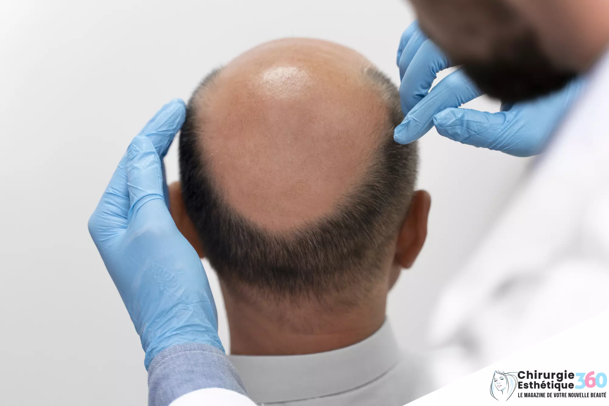 Photo de la procédure d'extraction d'unités folliculaires pour l'implant capillaire