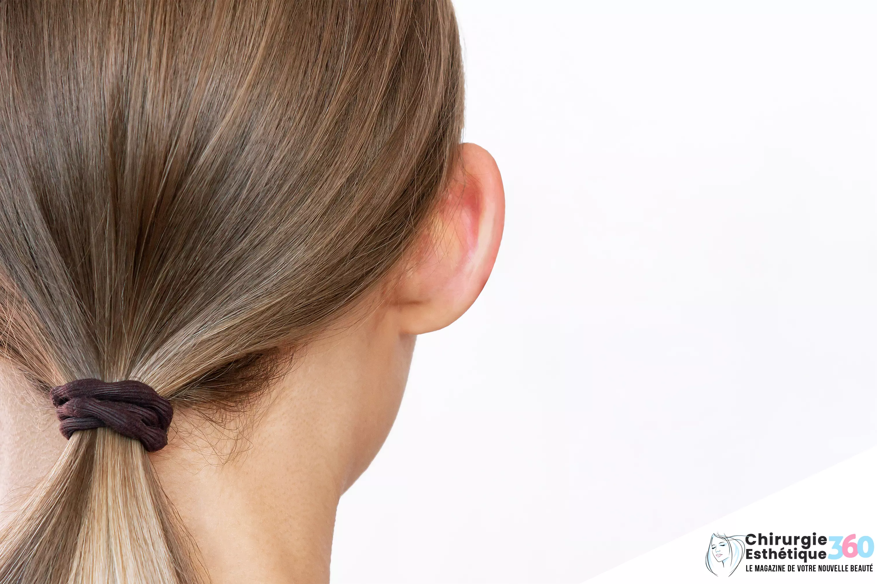 Correction des Oreilles Décollées : Avant et Après Otoplastie