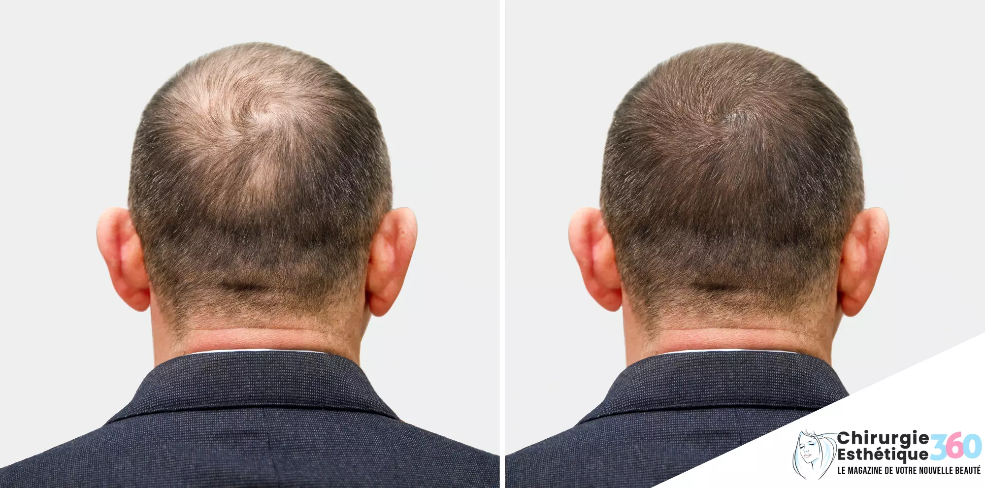 Photo d'un avant et après d'une greffe de cheveux