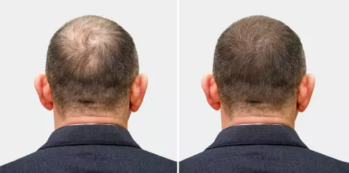 Photo d'un avant et après d'une greffe de cheveux