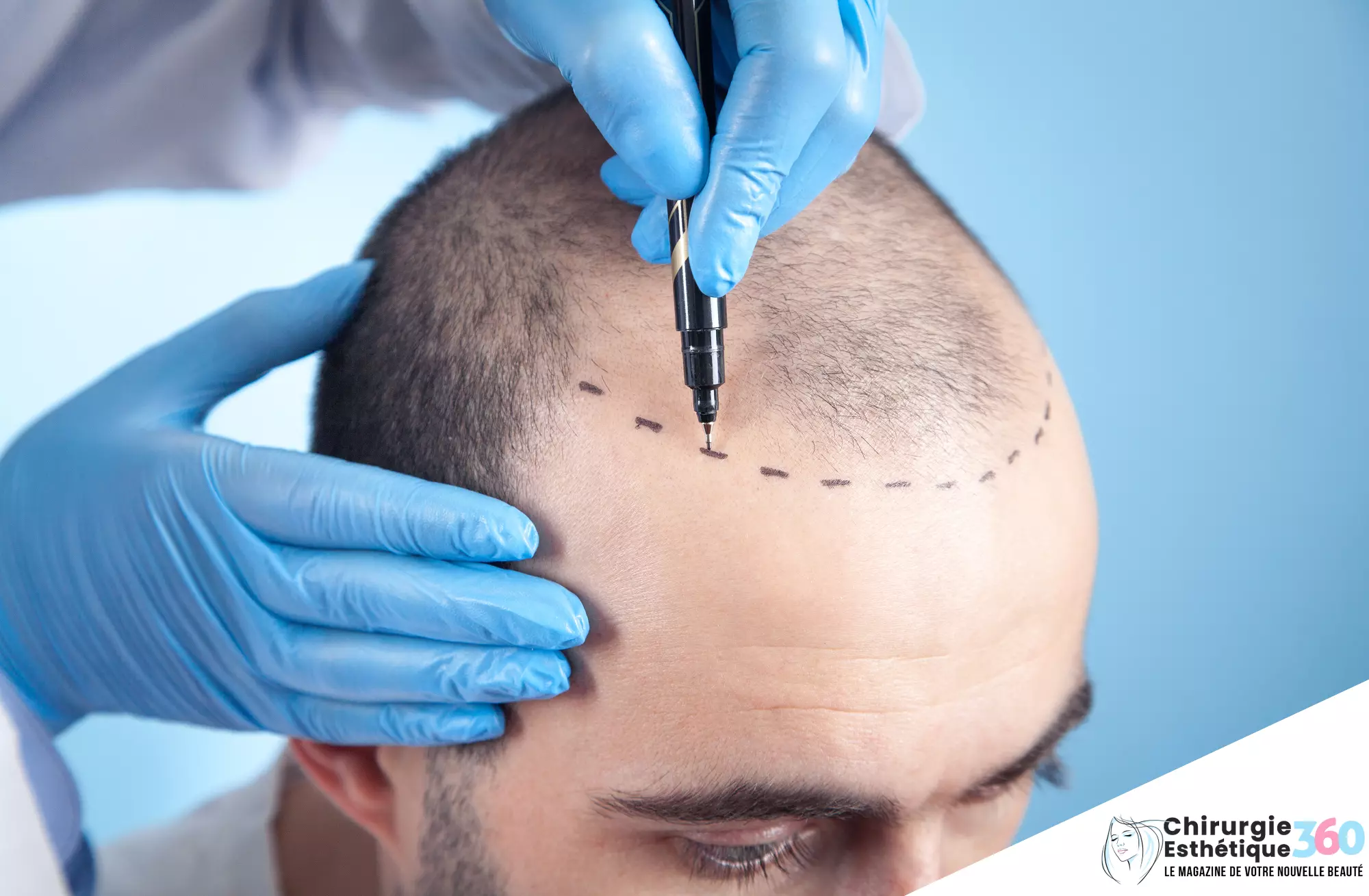 Photo d'une consultation pour la perte de cheveux : Traitement de l'implant capillaire avec un médecin