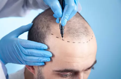 Photo d'une consultation pour la perte de cheveux : Traitement de l'implant capillaire avec un médecin