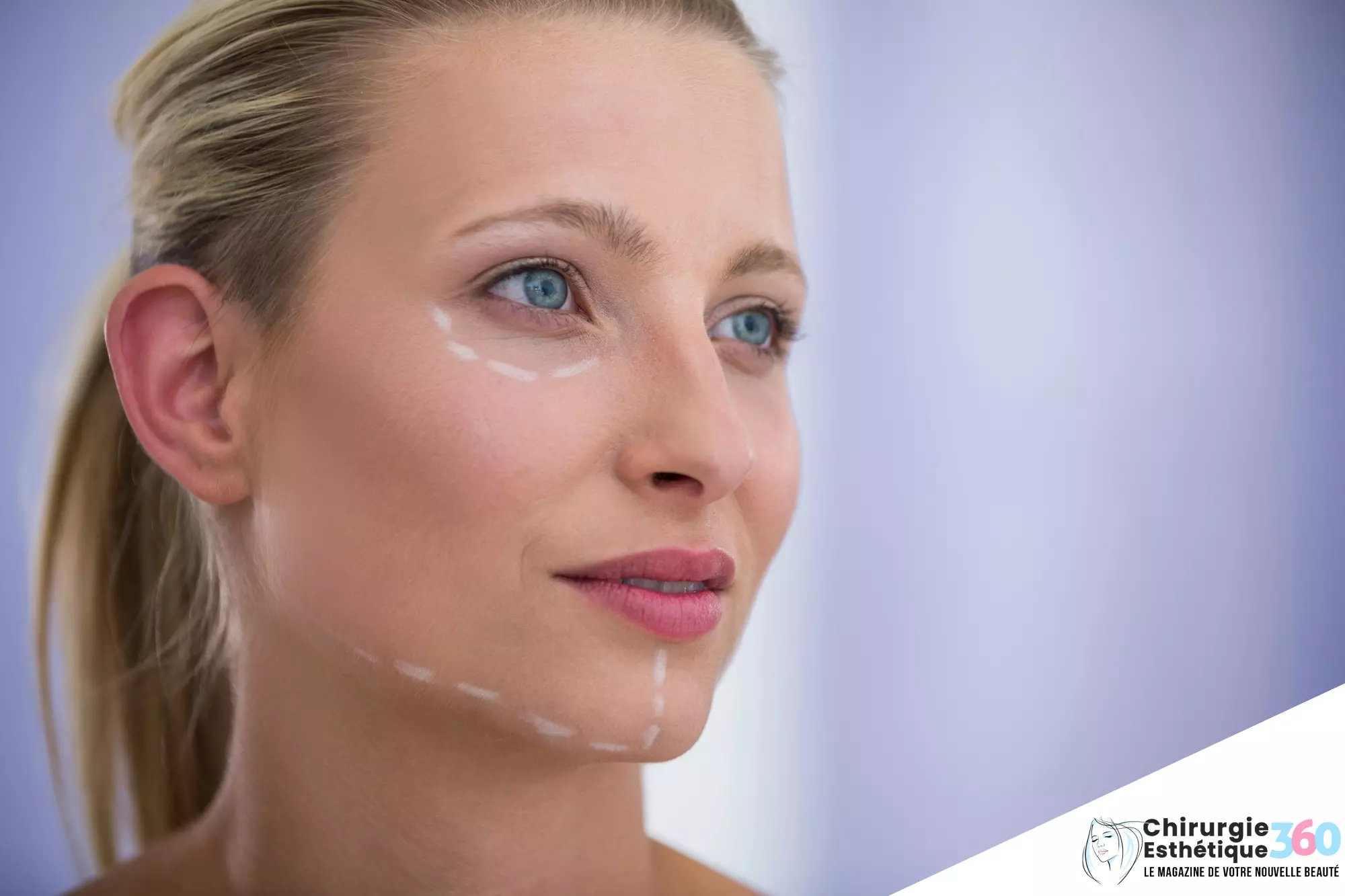 Implants faciaux pour une structure osseuse du visage sublimée : découvrez leur impact transformationnel