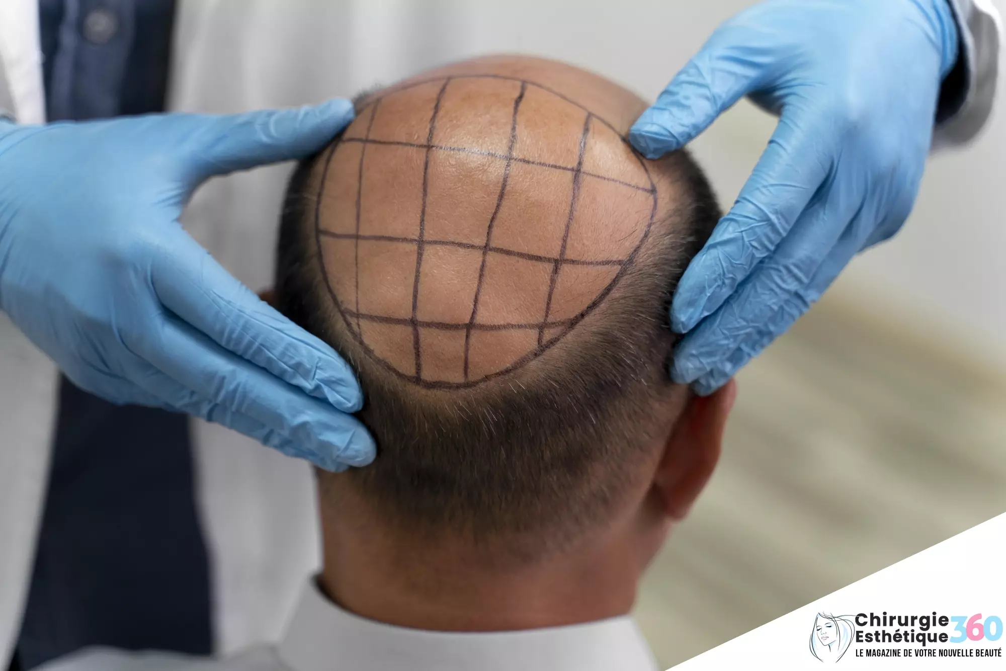 Photo d'une greffe capillaire par extraction d'unités folliculaires (FUE)