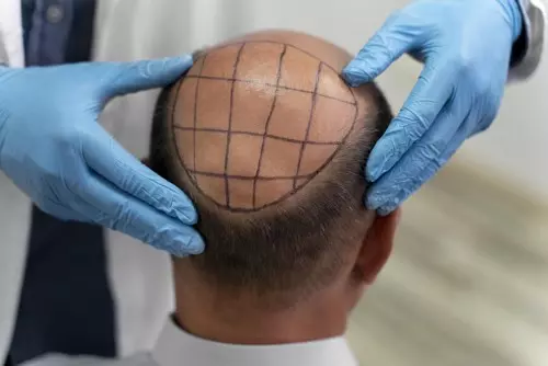 Photo d'une greffe capillaire par extraction d'unités folliculaires (FUE)