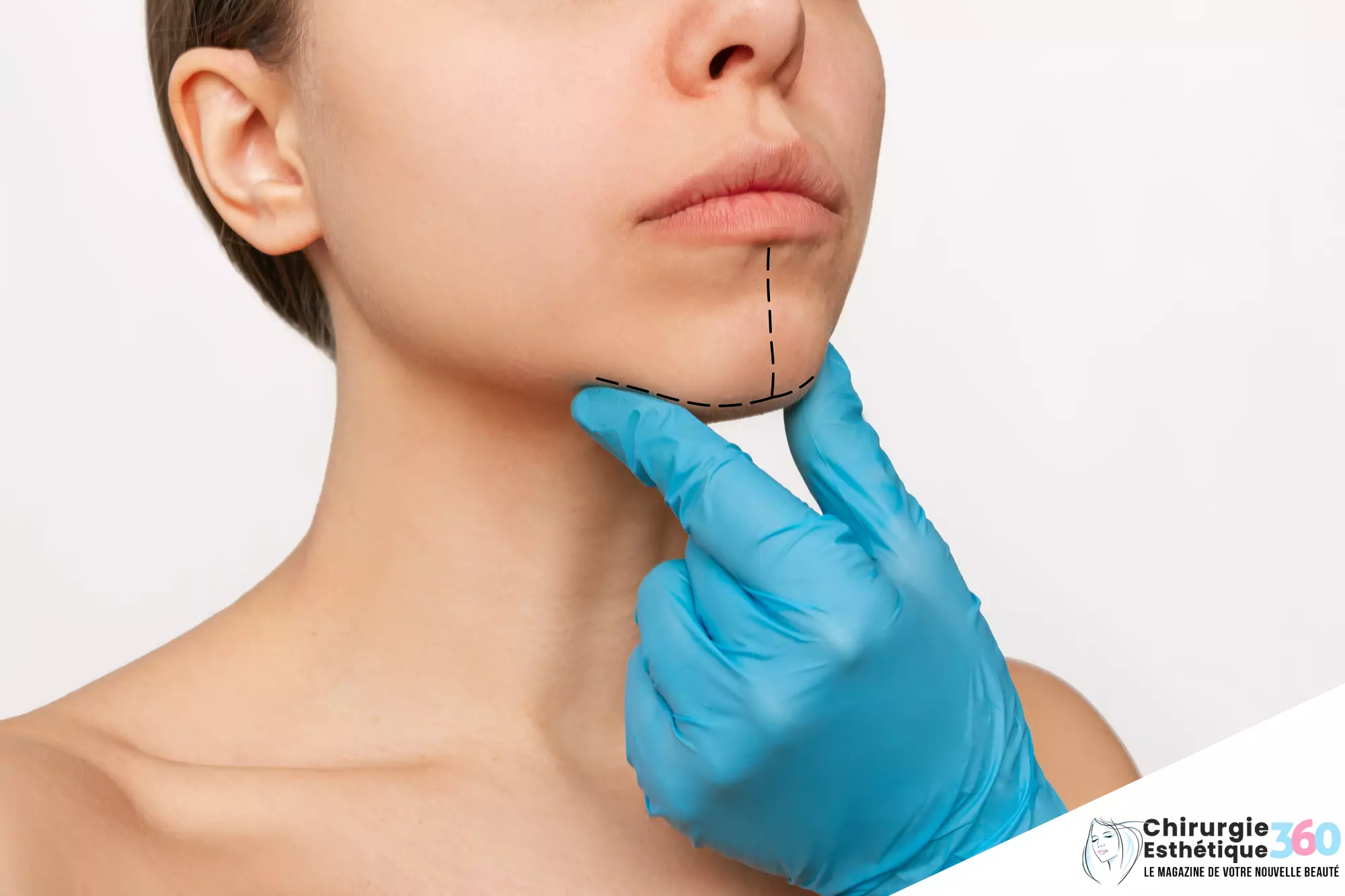 Photo du visage d'une jeune femme avant une chirurgie esthétique du menton