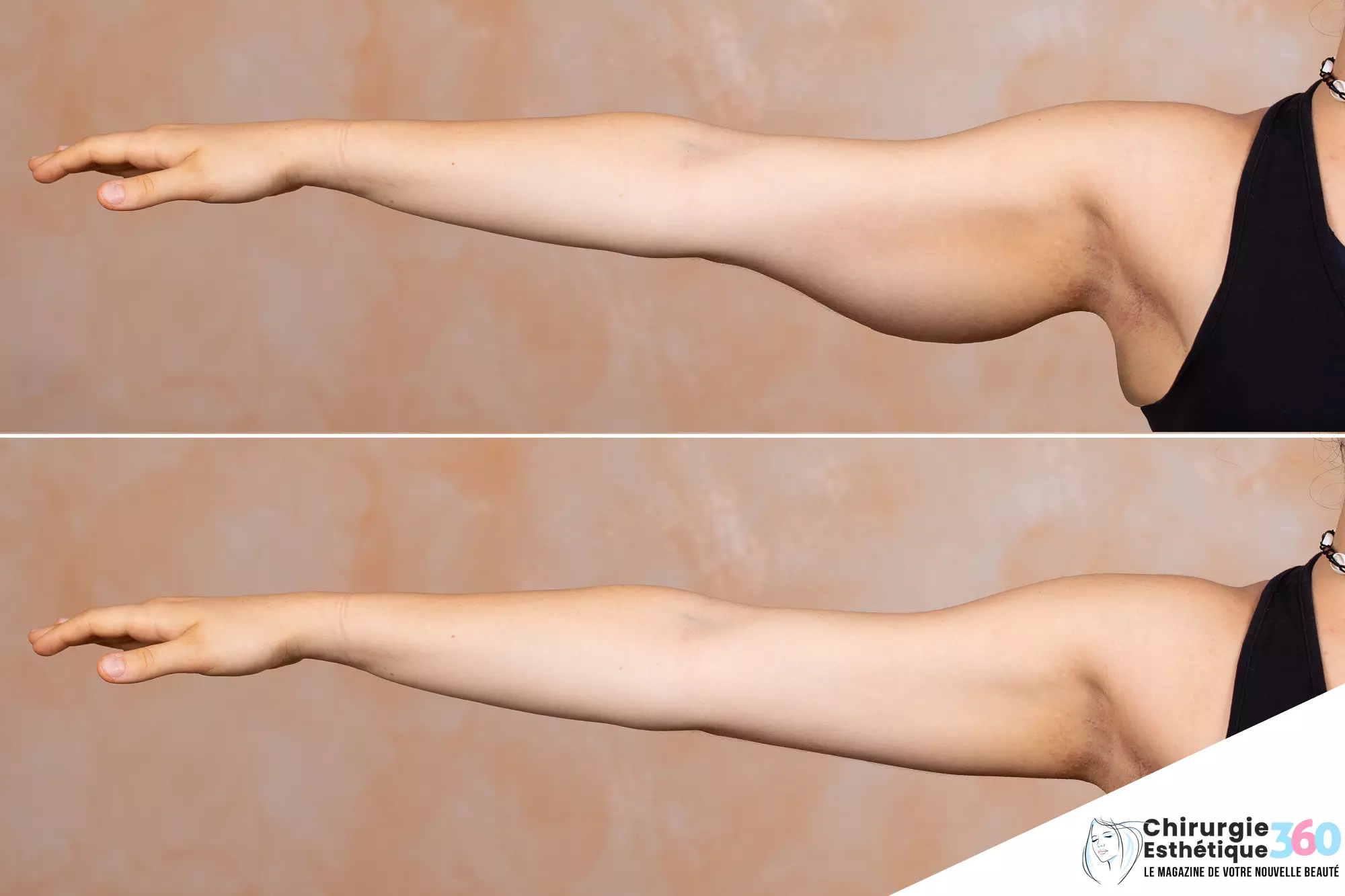 Avant et après : Transformation impressionnante suite à une brachioplastie - Lifting des bras