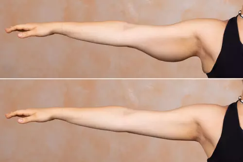 Avant et après : Transformation impressionnante suite à une brachioplastie - Lifting des bras