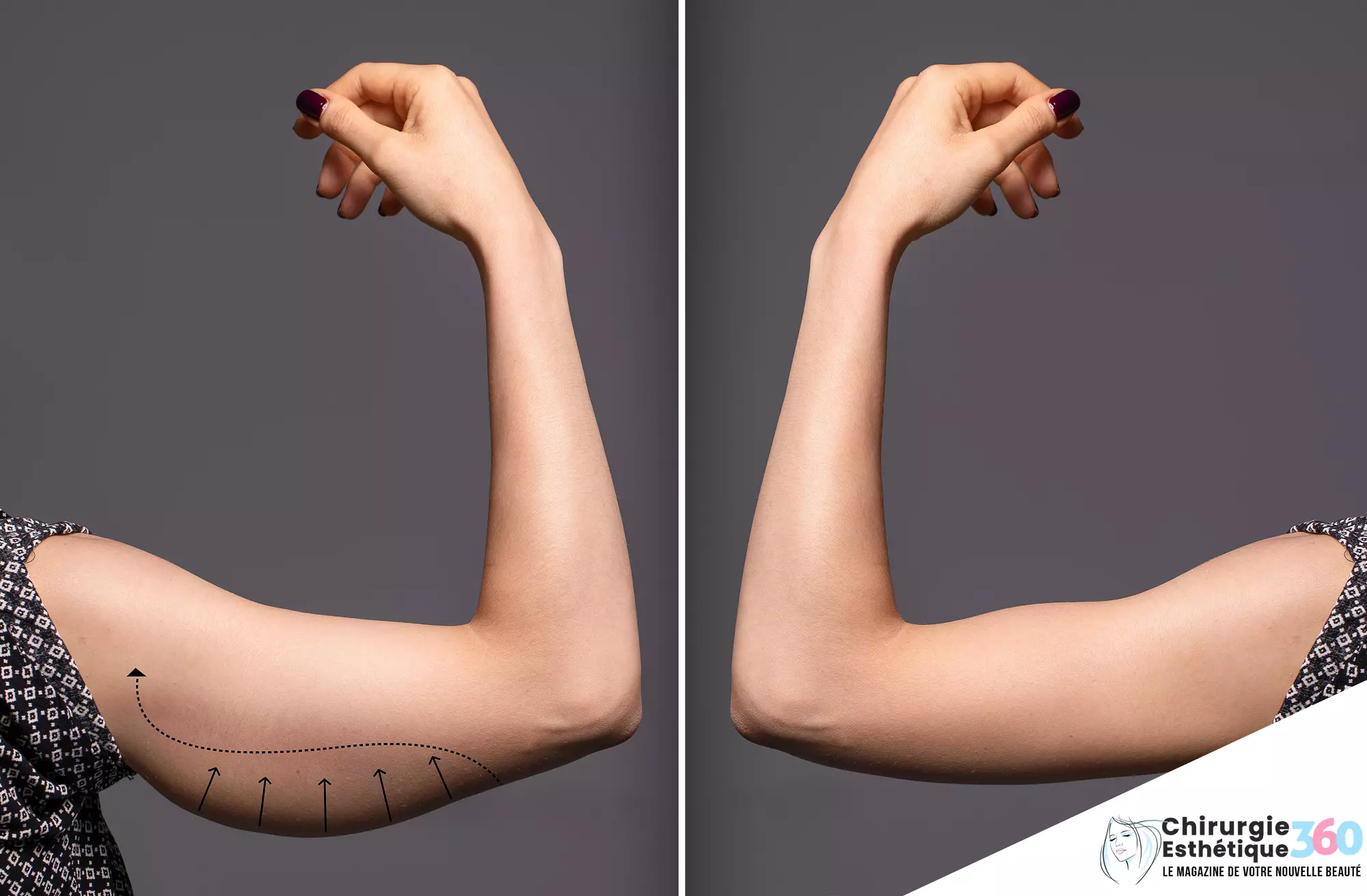 Brachioplastie : Transformation spectaculaire des bras grâce à la chirurgie - Avant et après
