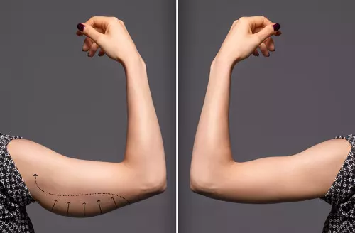 Brachioplastie : Transformation spectaculaire des bras grâce à la chirurgie - Avant et après